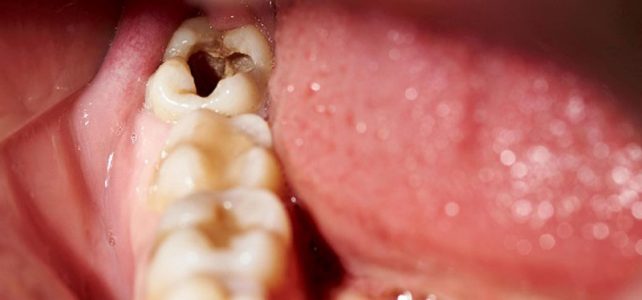 Zahngesundheit und Karies